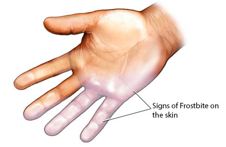 Frostbite Reticular Rash Adult Frostbite | BaroMedical Canada