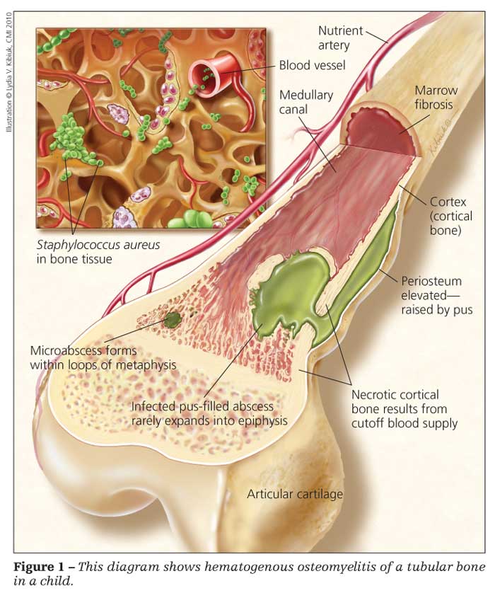 Resolution Bone Infection Bone infection - osteomyelitis | BaroMedical Canada