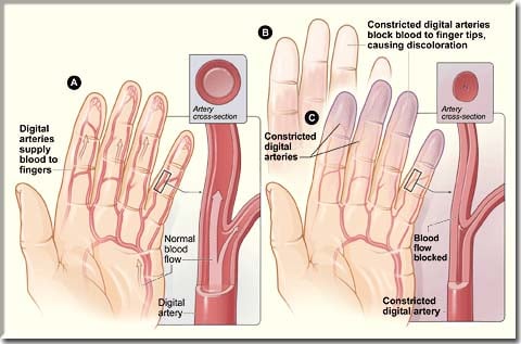 Raynauds