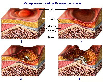 Source: www.spinal-injury.net/pressure-sores-sci.htm